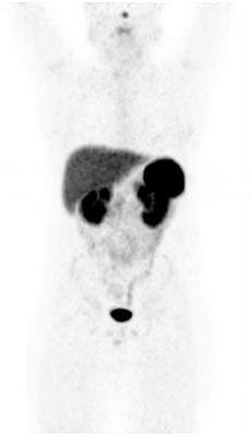 Normal Variants, Pitfalls and Artifacts in Ga-68 DOTATATE PET/CT Imaging